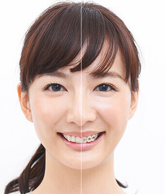 渋谷(表参道)|気づかれにい歯の矯正治療！経験豊富なオススメ歯科医はココ！